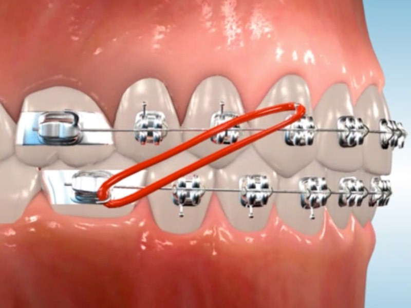 استفاده از الاستیک برای اتصال دو دندان